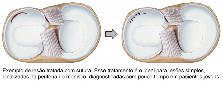 Dr Tales Cirurgia Do Joelho Menisco